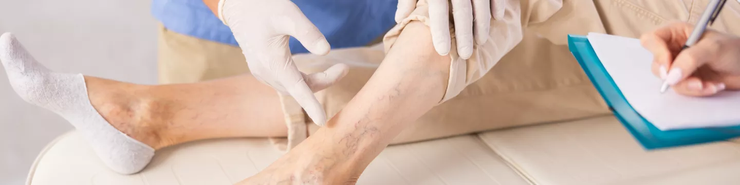 jambes de femme avec varices examiné