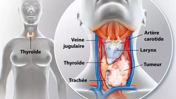 cancer de la thyroïde, symptômes et diagnostic